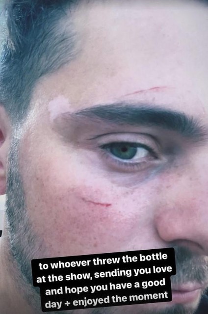 Op z’n Instagram Stories laat Garrix zijn lichte verwondingen zien. 