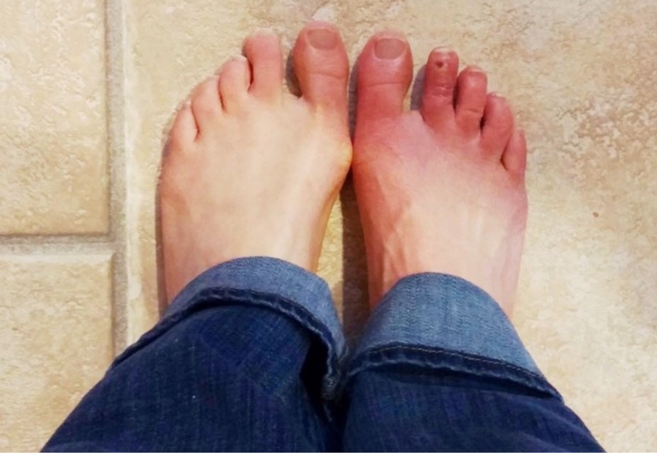Dokters vermoeden een simpele voetinfectie, maar voelt mijn hoofd in brand staat” | Het Nieuwsblad