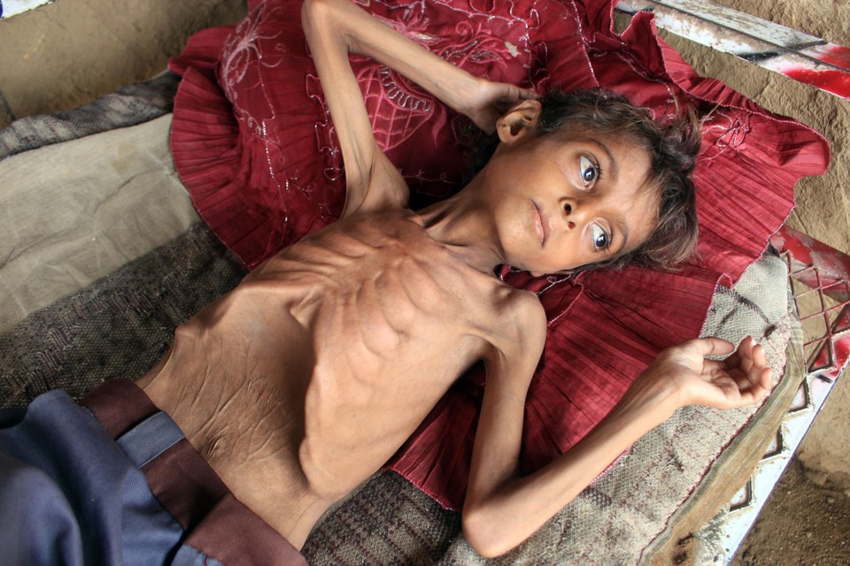 Hassan Razem, een tienjarige jongen uit het district Abs in Jemen, is zwaar ondervoed. 