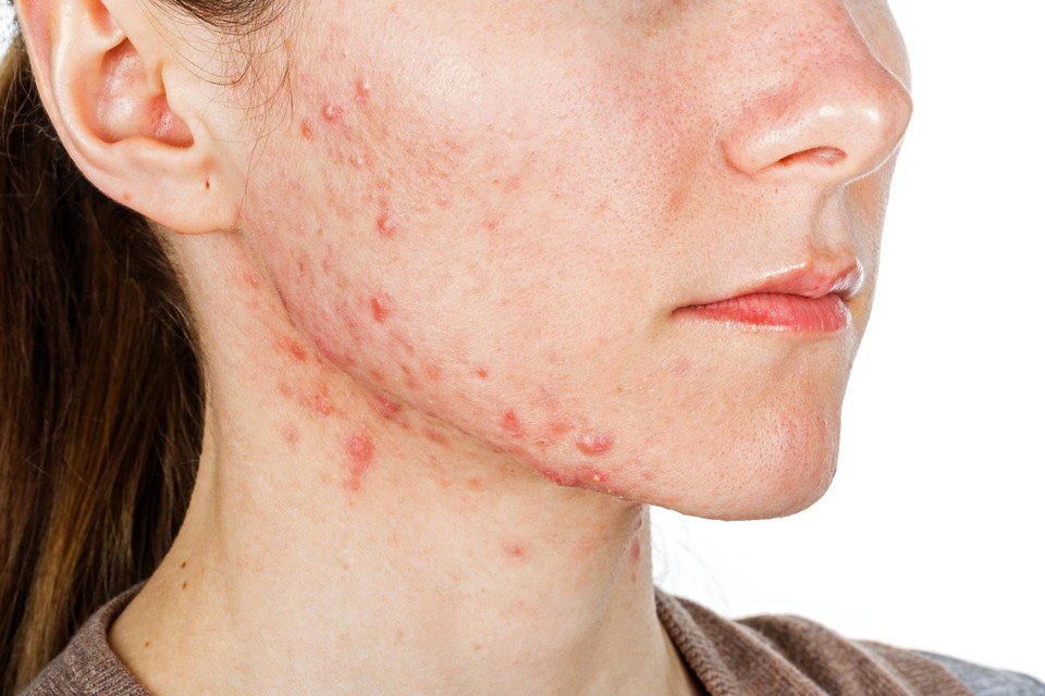 correct Flitsend Sluiting Wanneer moet je je zorgen maken over vlekje op je huid? Hoe behandel je acné?  Experts beantwoorden jullie vragen | Het Nieuwsblad Mobile